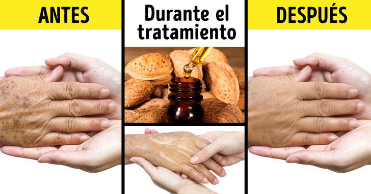 los-utiles-consejos-para-deshacerte-de-las-manchas-solares-en-la-piel-con-remedios-naturales-002